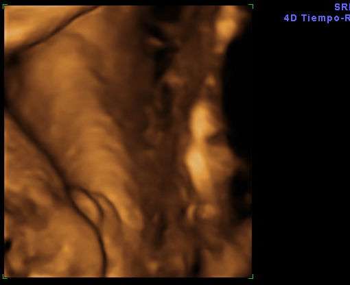 cuando se sabe exo del bebé en el embarazo imagen de una eocgrafía en 3 dimensiones que muestra los genitales de un feto niña
