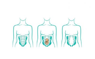 Diástasis abdominal, una causa de que no desaparezca la tripa del embarazo