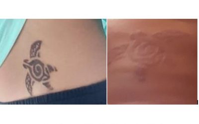 Cuidado con los tatuajes temporales de henna negra: pueden lesionar la piel