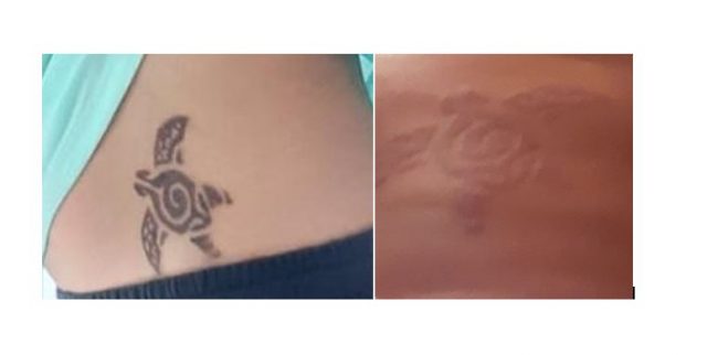 Cuidado con los tatuajes de henna negra, pueden dejar cicatriz