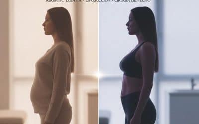 Qué es el Mommy Makeover, requisitos, beneficios y cuidados